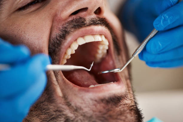 Dental Inlays and Onlays in De Witt, NY